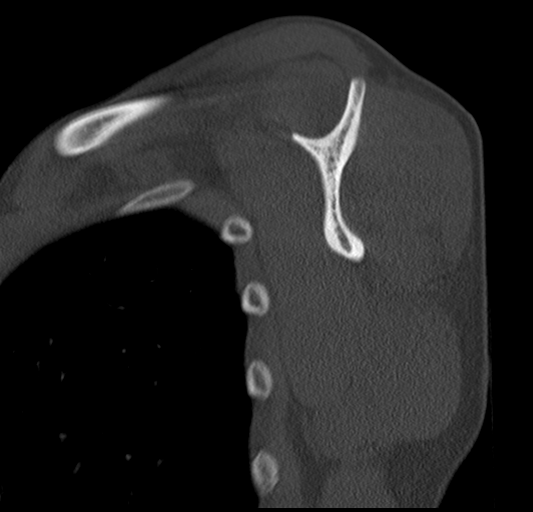 Posterior shoulder fracture-dislocation | Image | Radiopaedia.org