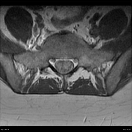 Myxopapillary ependymoma (hemorrhagic) | Image | Radiopaedia.org