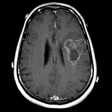 Glioblastoma IDH wild-type (with progression) | Radiology Case ...