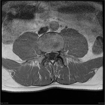 Myxopapillary ependymoma | Image | Radiopaedia.org