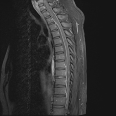 Viewing playlist: MRI Spine | Radiopaedia.org