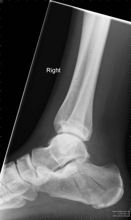 Calcaneal fracture | Radiology Case | Radiopaedia.org