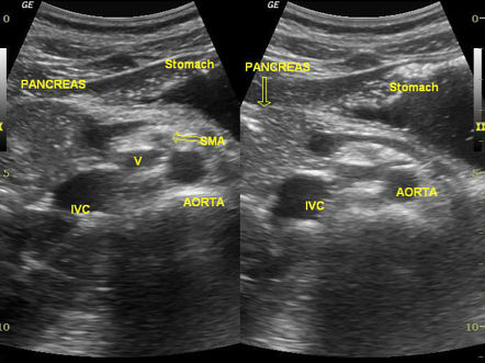 Dorsal pancreatic agenesis | Image | Radiopaedia.org