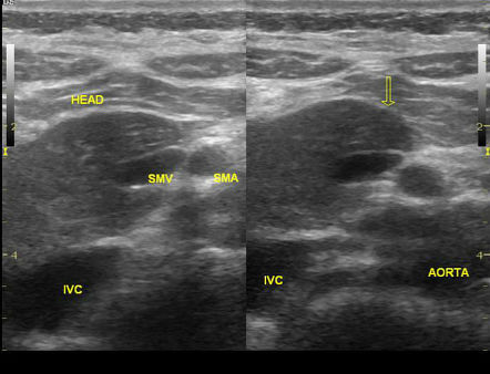 Dorsal pancreatic agenesis | Radiology Case | Radiopaedia.org