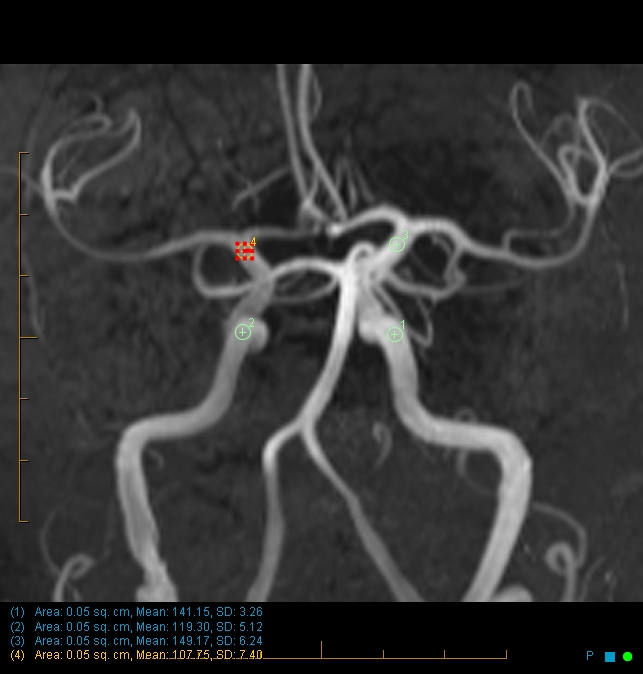 High Grade Proximal Ica Stenosis Intracranial Mra Findings Image