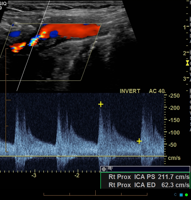 High grade proximal ICA stenosis - intracranial MRA findings | Image ...