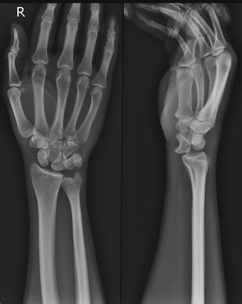 Trans-scaphoid lunate dislocation | Image | Radiopaedia.org