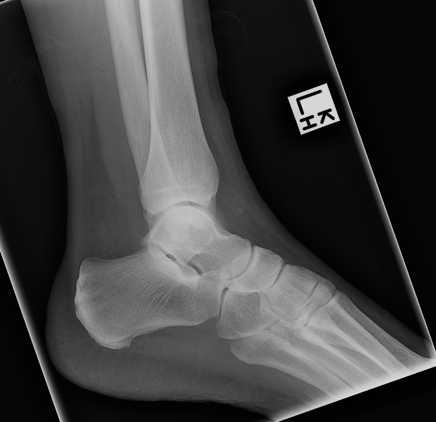 Ankle fracture - Weber A | Image | Radiopaedia.org