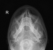 paranasal sinuses x ray