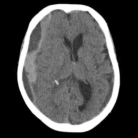 Midline shift (summary) | Radiology Reference Article | Radiopaedia.org