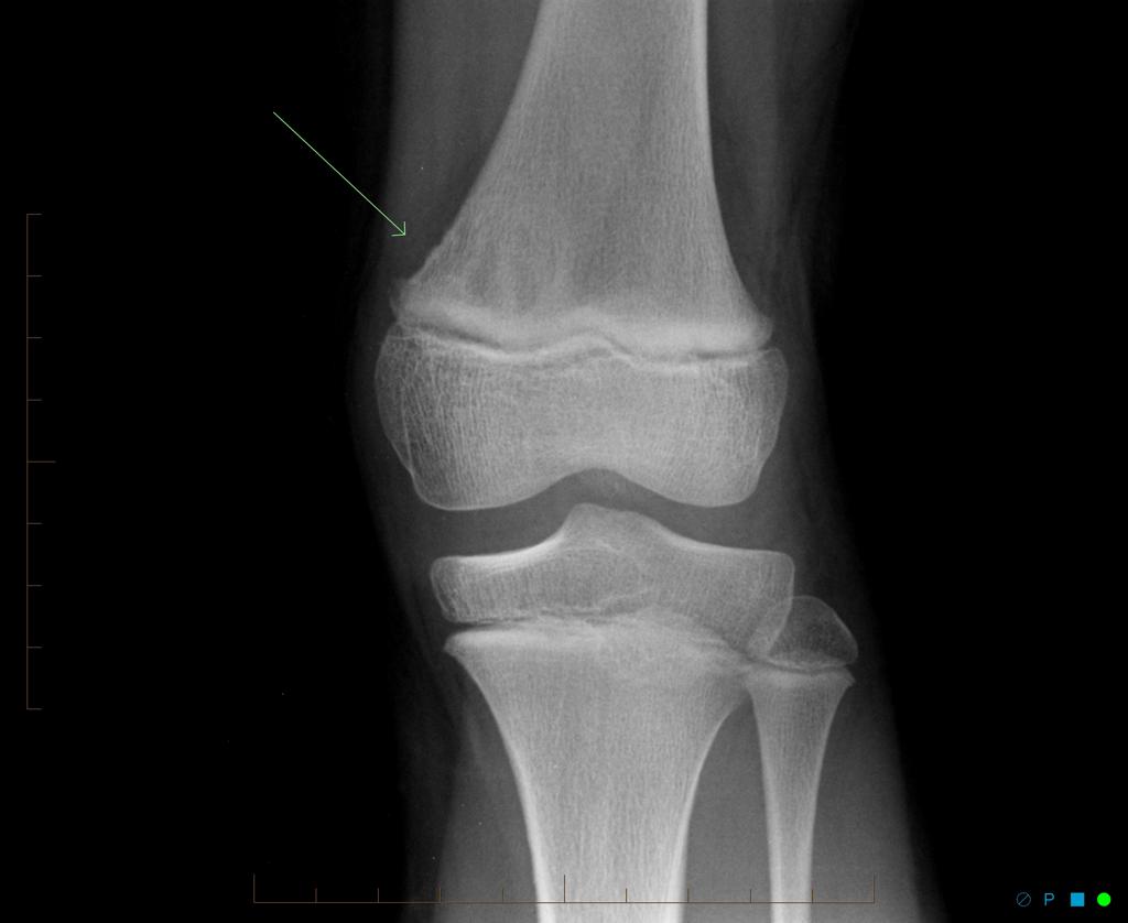 Cortical Desmoid Radiology Case Radiopaedia Org