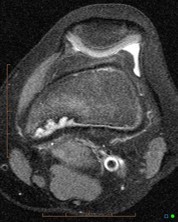 Cortical Desmoid Image Radiopaedia Org