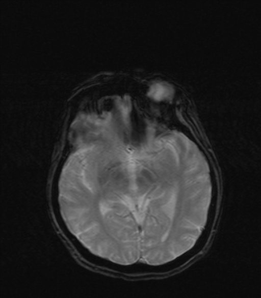 Multiple System Atrophy | Image | Radiopaedia.org