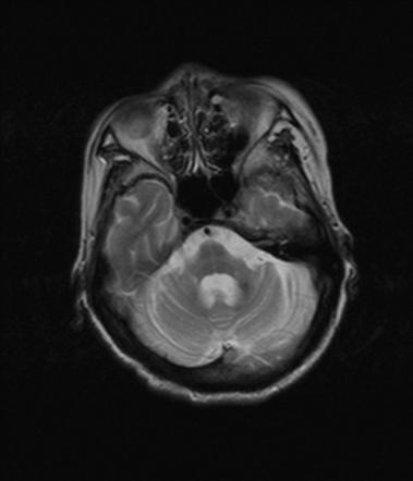 multiple system atrophy case study