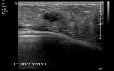 Neurofibromatosis Of Breast 