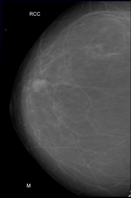 Birads Iv Breast Lesion Image