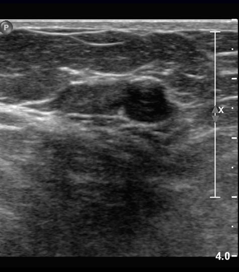 Birads Iv Breast Lesion 