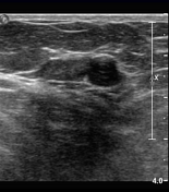 Breast ultrasound | Radiology Reference Article | Radiopaedia.org