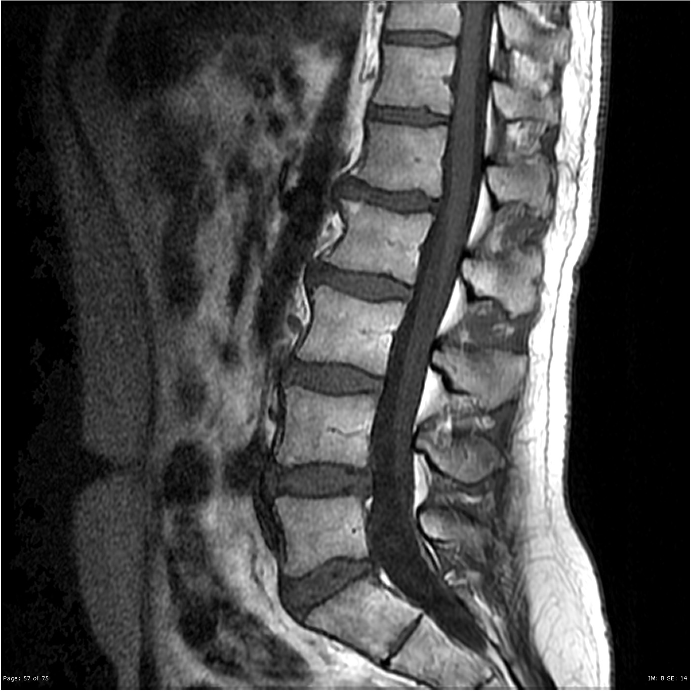 Spinal dural arteriovenous fistula | Image | Radiopaedia.org