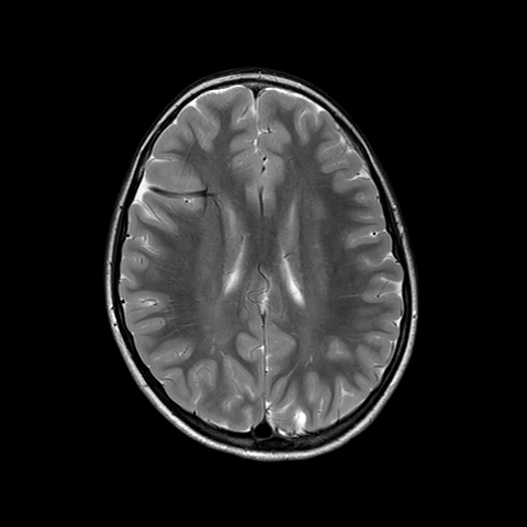 Developmental venous anomalies (DVA) with caput medusae | Image ...