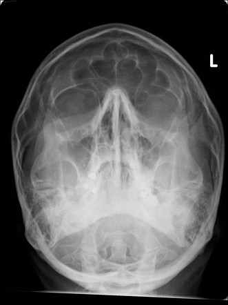 Facial bones - normal | Radiology Case | Radiopaedia.org