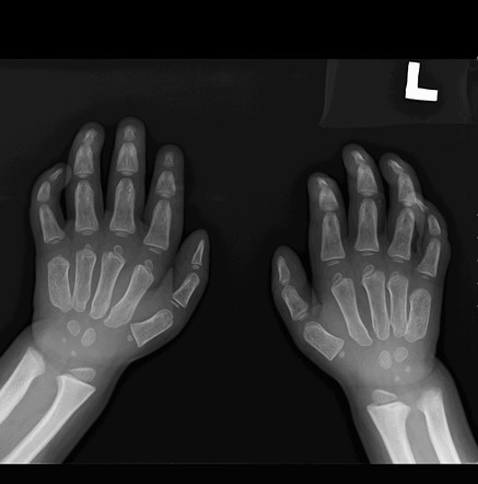 Mucopolysaccharidoses | Image | Radiopaedia.org