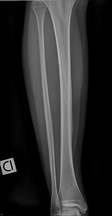 Medial tibial stress syndrome | Image | Radiopaedia.org