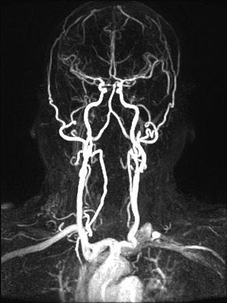 Subclavian Steel Syndrome And Bovine Arch 