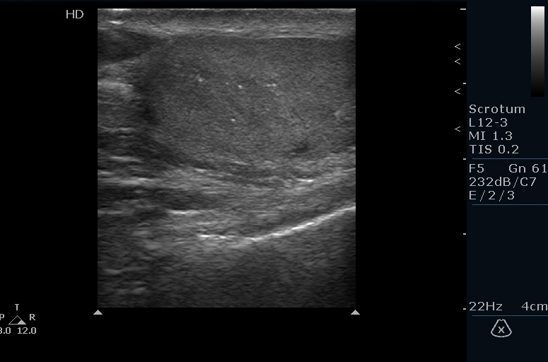 Testicular Microlithiasis Image