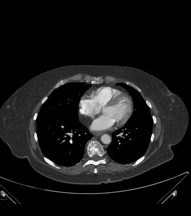 Lipomatous Hypertrophy Of The Interatrial Septum Radiology Reference