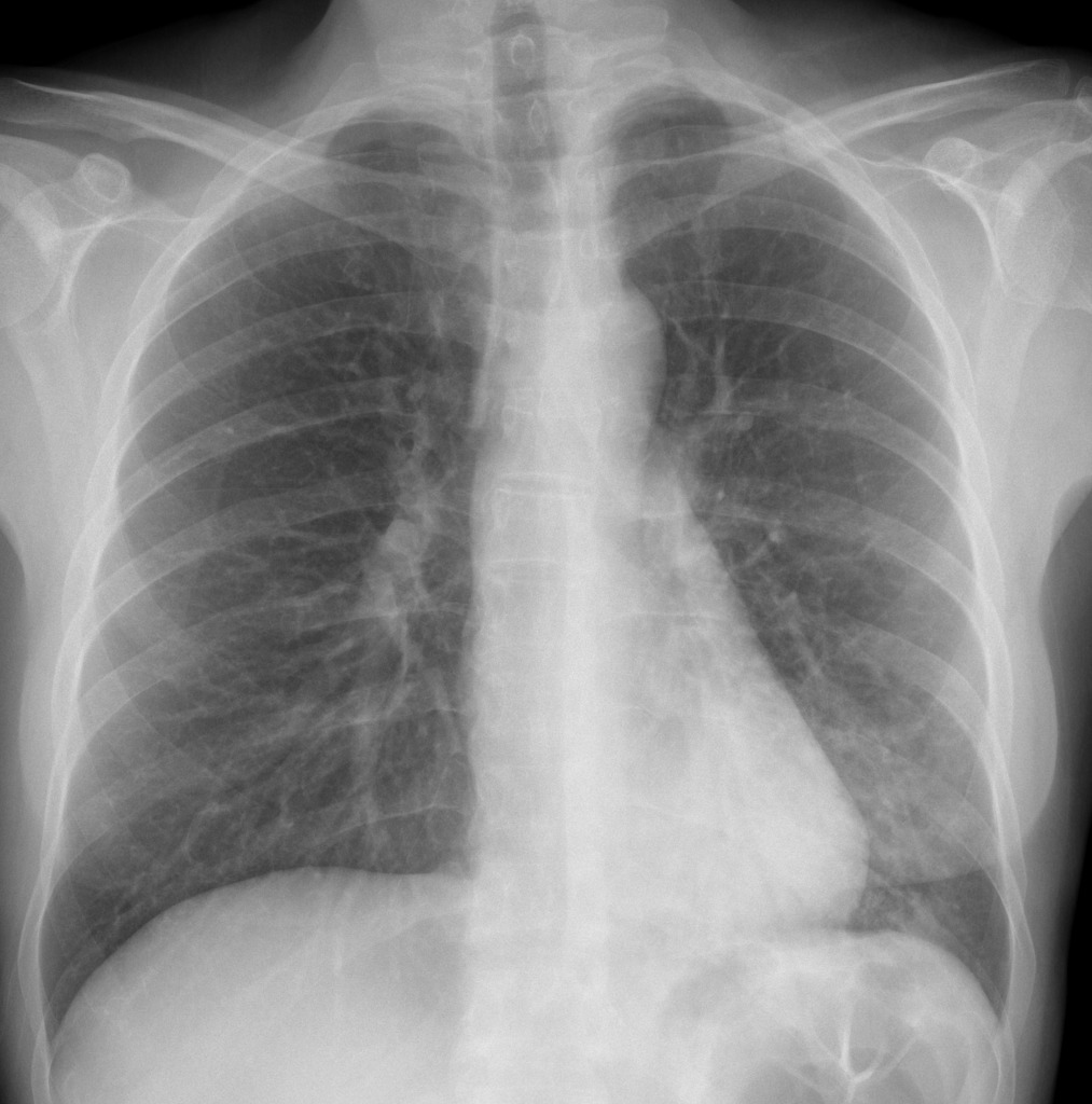 Left Lower Lobe Pneumonia Retrocardiac Consolidation Radiology Case Radiopaedia Org