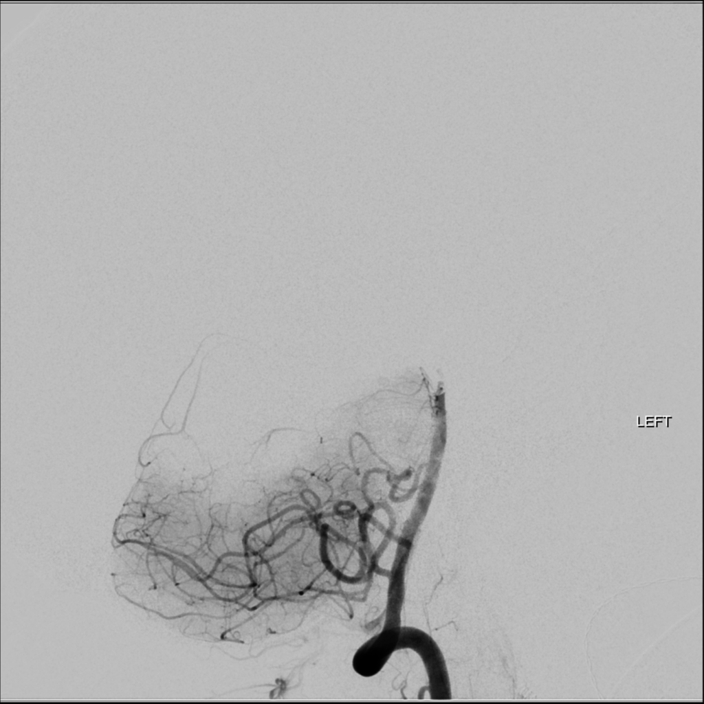 Basilar tip thrombus with endovascular clot retrieval | Image ...