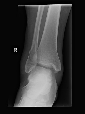 Trimalleolar equivalent fracture | Image | Radiopaedia.org