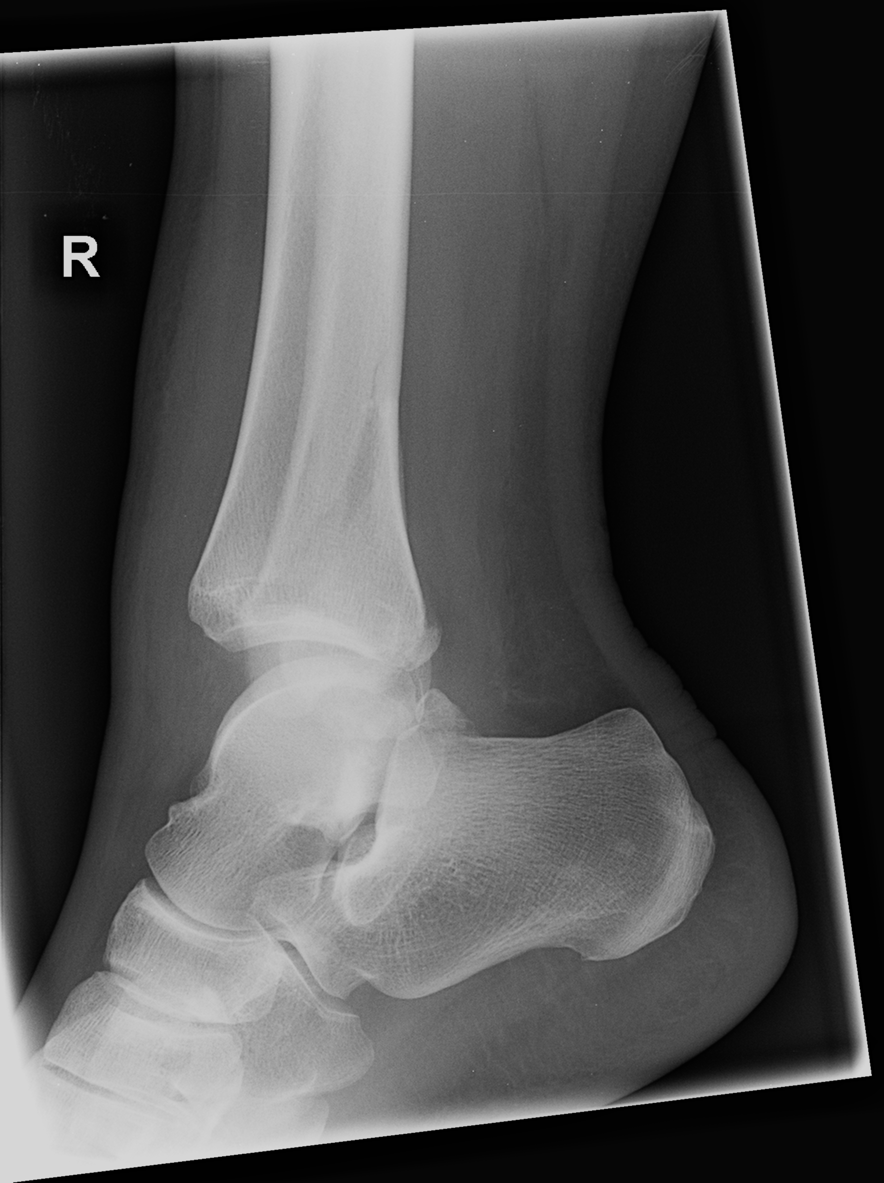 Isolated Anterior Compartment Syndrome After A, 55% OFF