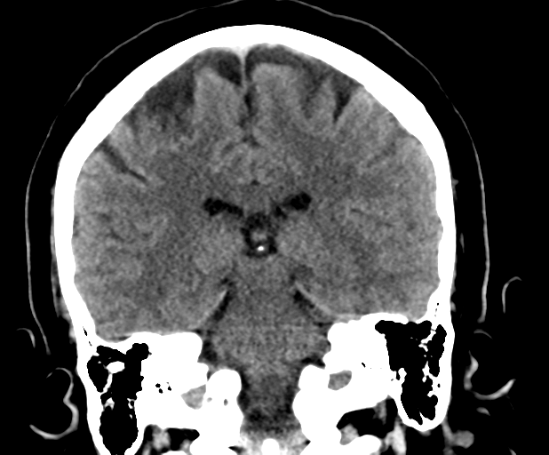 Encephalocoeles (multiple) | Image | Radiopaedia.org