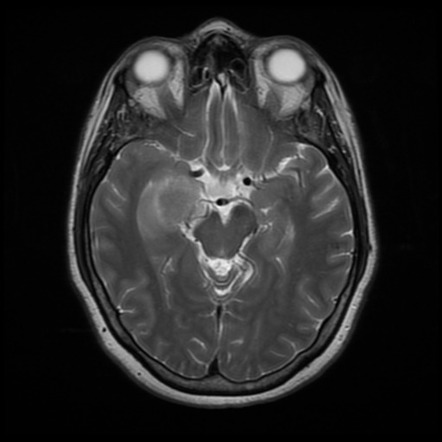 Meningioma: cavernous sinus | Image | Radiopaedia.org