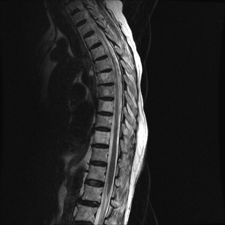 Anterior spinal artery syndrome | Image | Radiopaedia.org