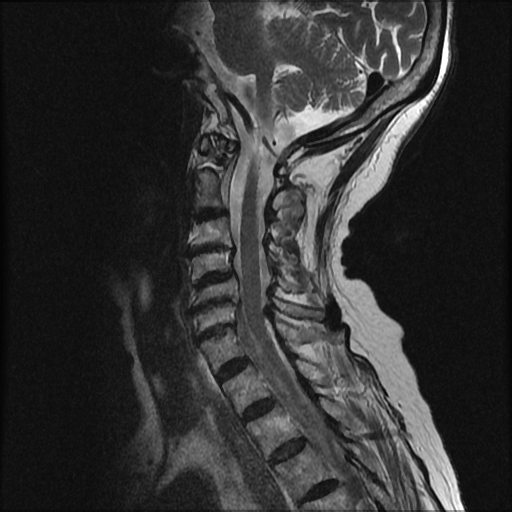 Long segment T2 hyperintensity in dorsal cord - anterior cord syndrome ...