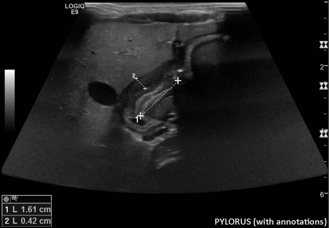 Hypertrophic Pyloric Stenosis Image