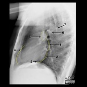 Chest (lateral view) | Radiology Reference Article | Radiopaedia.org