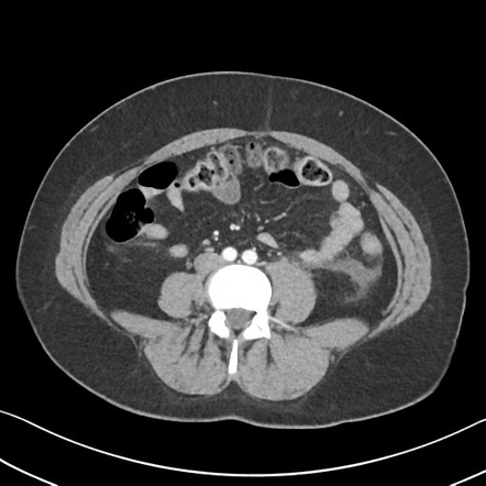 Hypertriglyceridemia-induced acute pancreatitis | Radiology Case ...