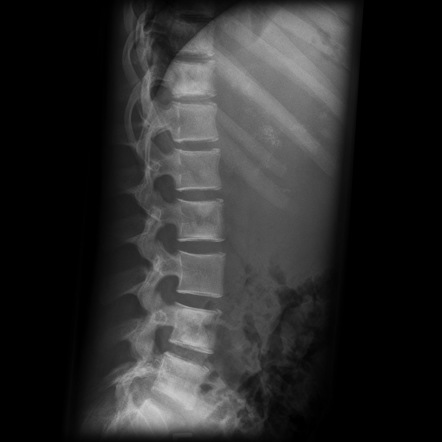 sclerotic metastases metastatic radiopaedia radiology neuroblastoma differential diagnosis foci