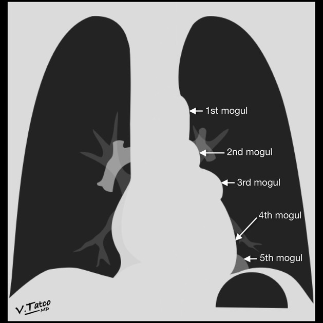 Third mogul sign Radiology Reference Article Radiopaedia