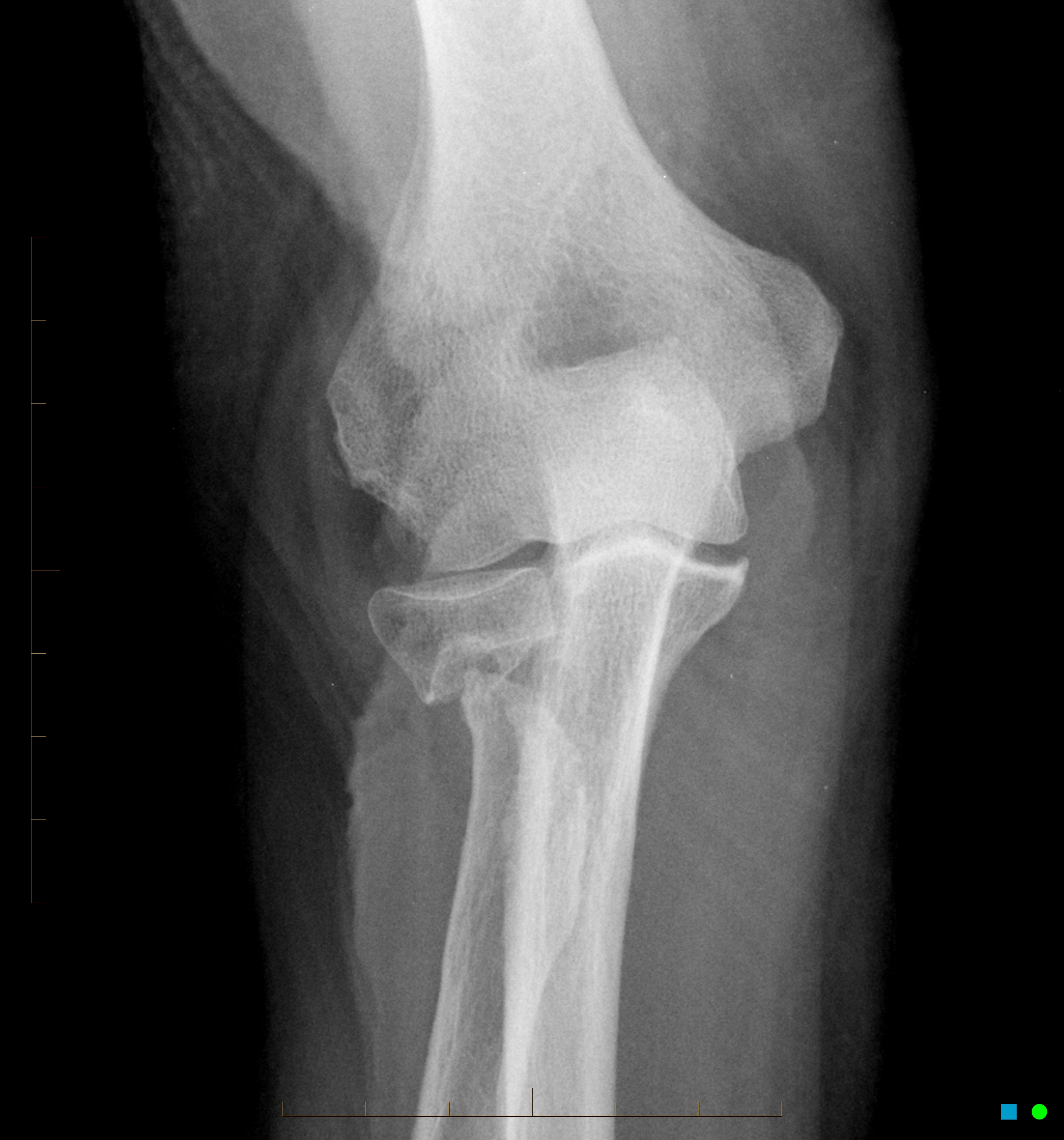 Non-union neck of radius fracture | Image | Radiopaedia.org