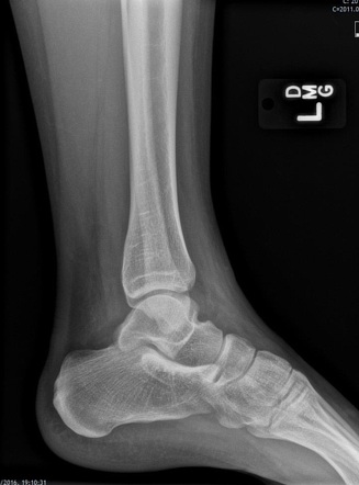 Normal lateral ankle radiograph | Radiology Case | Radiopaedia.org