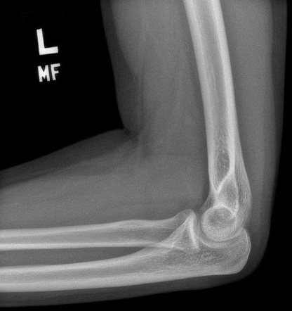 Lateral Epicondylitis Xray