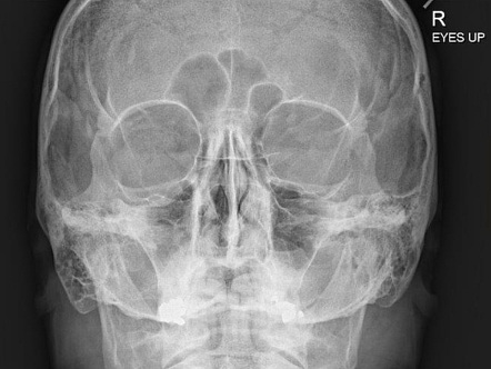 Normal orbits radiograph | Radiology Case | Radiopaedia.org