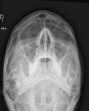 Normal facial OM30 radiograph | Radiology Case | Radiopaedia.org