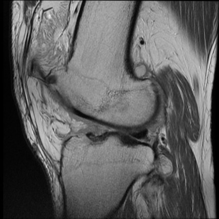 Lipoma arborescens | Radiology Case | Radiopaedia.org