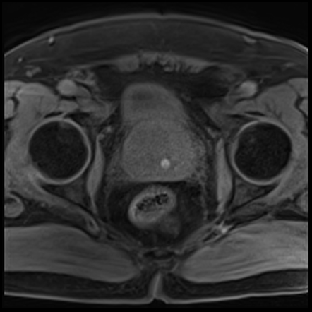 Prostate cancer - PI-RADS 3 apical nodule | Radiology Case ...